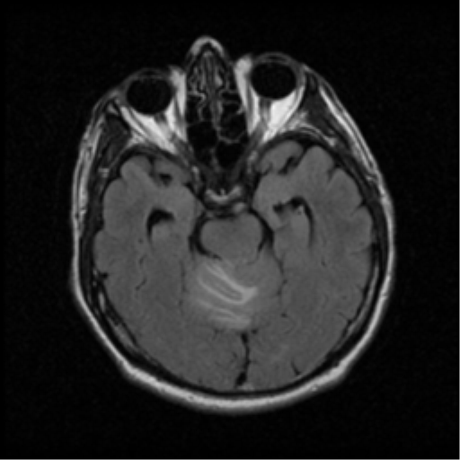 File:Acoustic schwannoma (Radiopaedia 39170-41387 Axial FLAIR 8).png
