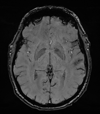 Acoustic schwannoma (Radiopaedia 50846-56358 Axial SWI 46).png