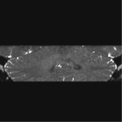 File:Acoustic schwannoma (Radiopaedia 50846-56358 Coronal T2 8).png