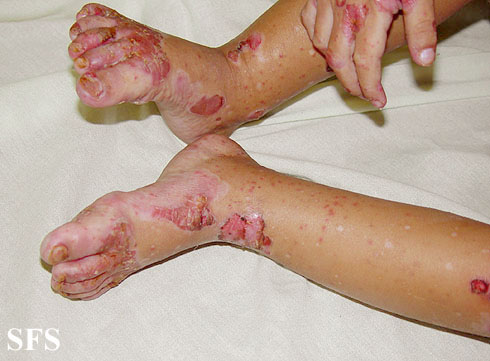 File:Acrodermatitis Enteropathica (Dermatology Atlas 20).jpg