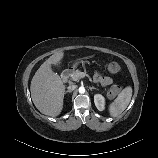 Acromioclavicular joint cyst (Radiopaedia 58455-65610 Axial C+ arterial phase 110).jpg