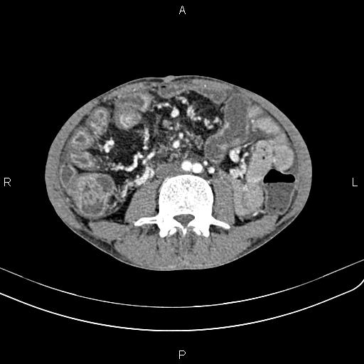 Active crohn disease (Radiopaedia 87133-103397 Axial C+ arterial phase 58).jpg