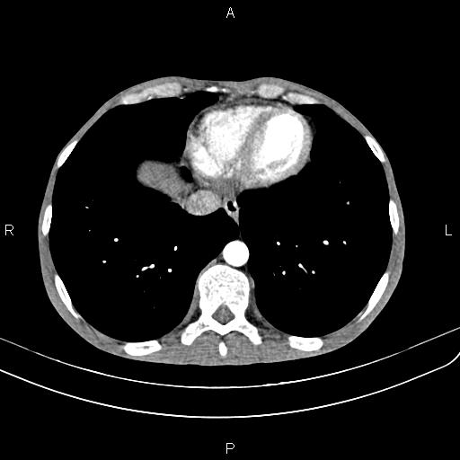 Active crohn disease (Radiopaedia 87133-103397 Axial C+ arterial phase 9).jpg