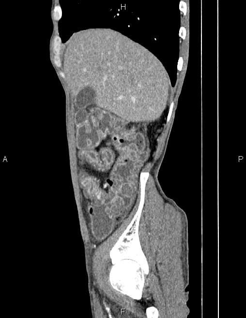 Active crohn disease (Radiopaedia 87133-103397 Sagittal C+ arterial phase 15).jpg