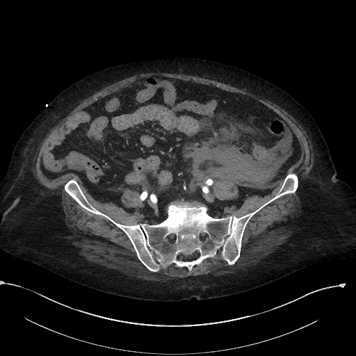 File:Active renal extravasation with large subcapsular and retroperitoneal hemorrhage (Radiopaedia 60975-68796 Axial C+ arterial phase 138).jpg
