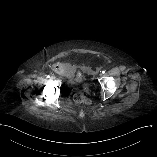 Active renal extravasation with large subcapsular and retroperitoneal hemorrhage (Radiopaedia 60975-68796 Axial C+ arterial phase 182).jpg