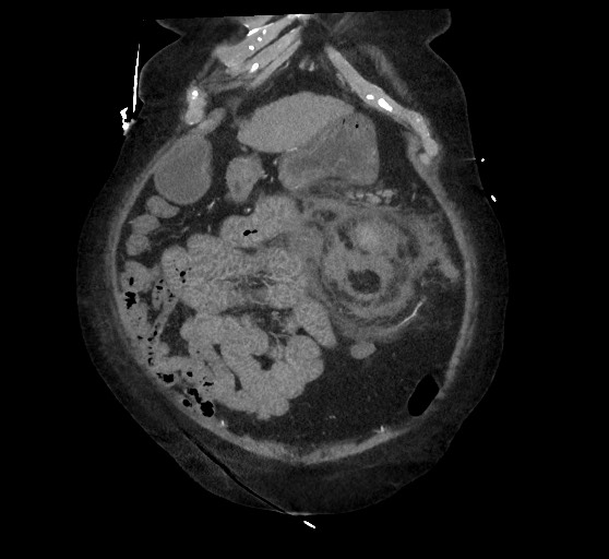 Active renal extravasation with large subcapsular and retroperitoneal hemorrhage (Radiopaedia 60975-68796 Coronal C+ arterial phase 39).jpg