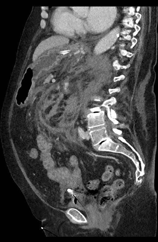 Active renal extravasation with large subcapsular and retroperitoneal hemorrhage (Radiopaedia 60975-68796 Sagittal C+ portal venous phase 110).jpg