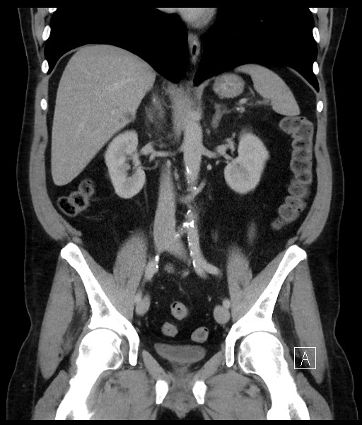 Acute-on-chronic pancreatitis (Radiopaedia 67286-76656 Coronal C+ portal venous phase 44).jpg