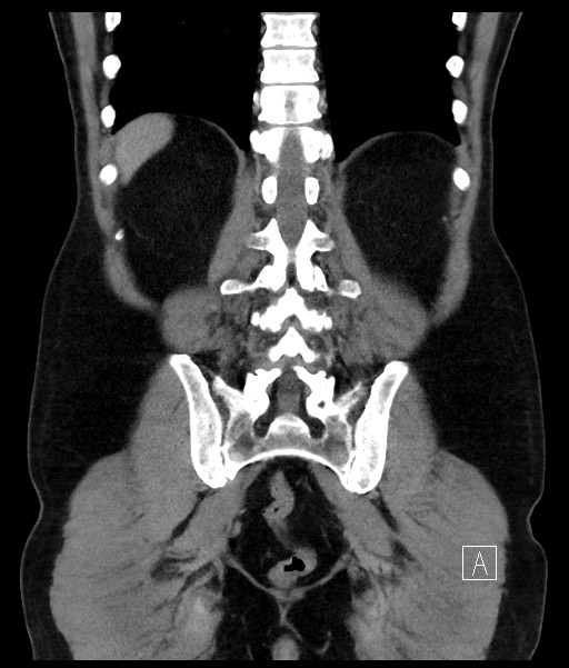 Acute-on-chronic pancreatitis (Radiopaedia 67286-76656 Coronal C+ portal venous phase 58).jpg