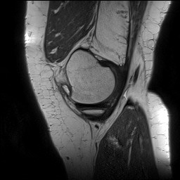 Acute-on-chronic transient lateral patellar dislocation with trochlear dysplasia (Radiopaedia 84099-99349 Sagittal PD 37).jpg