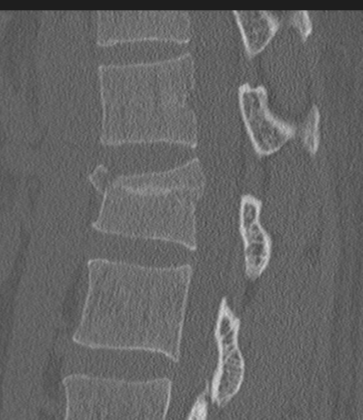 Acute L1 burst compression fracture (Radiopaedia 34430-35755 Sagittal bone window 30).png