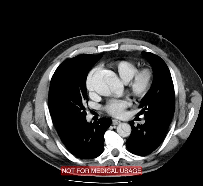 Acute aortic dissection - Stanford type A (Radiopaedia 40661-43285 Axial C+ portal venous phase 28).jpg