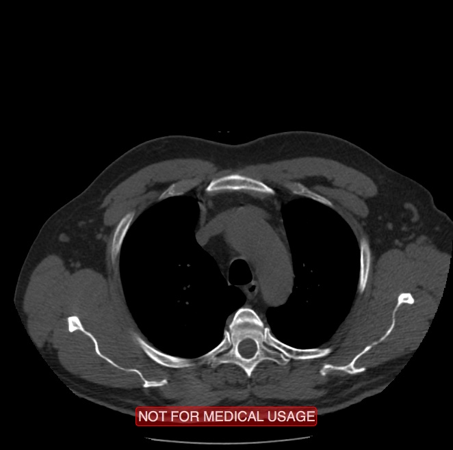 Acute aortic dissection - Stanford type A (Radiopaedia 40661-43285 Axial non-contrast 1).jpg