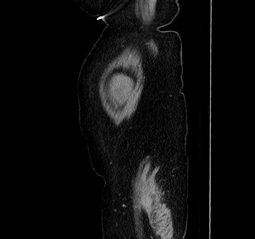 Acute appendicitis, heterotaxy syndrome (Radiopaedia 66884-76202 Sagittal C+ portal venous phase 17).jpg