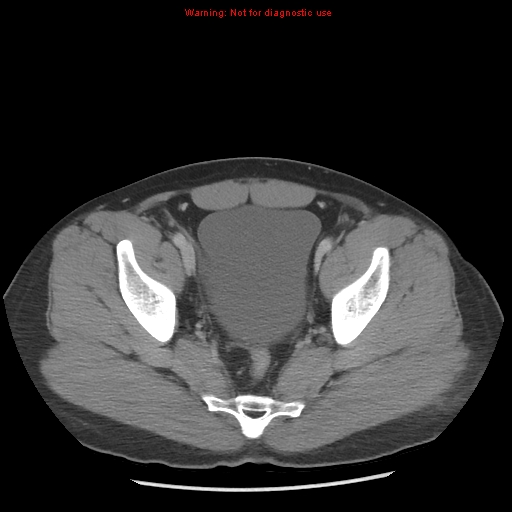 Acute appendicitis (Radiopaedia 10498-10973 Axial C+ portal venous phase 49).jpg