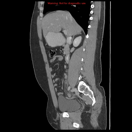 File:Acute appendicitis (Radiopaedia 10498-10973 Sagittal C+ portal venous phase 18).jpg