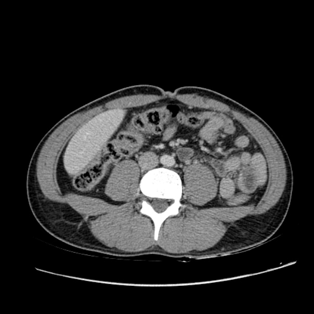 Acute appendicitis (Radiopaedia 27049-27227 Axial C+ portal venous phase 41).jpg