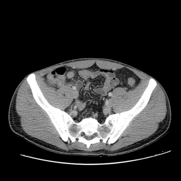 Acute appendicitis (Radiopaedia 27049-27227 Axial C+ portal venous phase 58).jpg