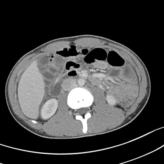 Acute appendicitis (Radiopaedia 32614-33572 Axial C+ portal venous phase 28).jpg