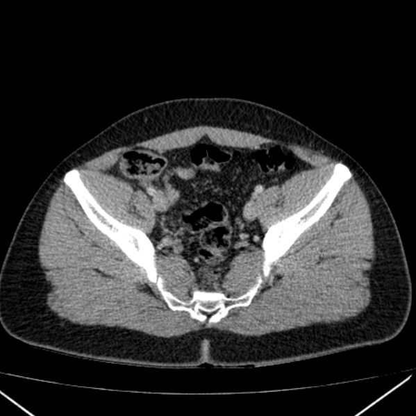 Acute appendicitis (Radiopaedia 38255-40270 Axial C+ portal venous phase 91).jpg