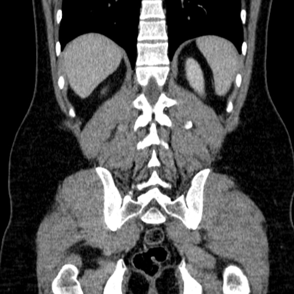 Acute appendicitis (Radiopaedia 38255-40270 Coronal C+ portal venous phase 67).jpg