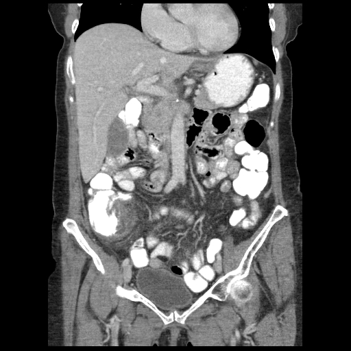 Acute appendicitis (Radiopaedia 52672-58589 Coronal C+ portal venous phase 37).jpg