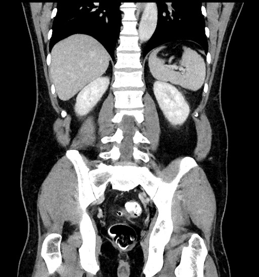 Acute appendicitis (Radiopaedia 77016-88960 Coronal C+ portal venous phase 69).jpg