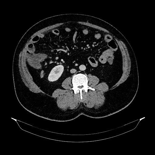 Acute appendicitis (Radiopaedia 79950-93224 Axial C+ portal venous phase 57).jpg