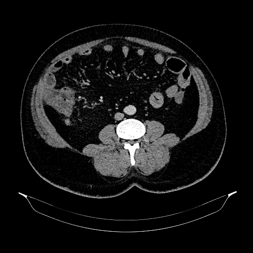 File:Acute appendicitis (Radiopaedia 79950-93224 Axial C+ portal venous phase 60).jpg
