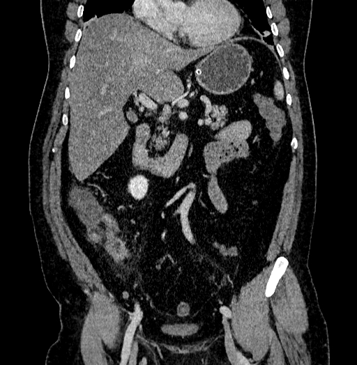 File:Acute appendicitis (Radiopaedia 79950-93224 Coronal C+ portal venous phase 42).jpg