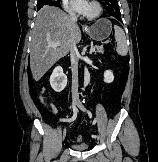 Acute appendicitis (Radiopaedia 79950-93224 Coronal C+ portal venous phase 48).jpg