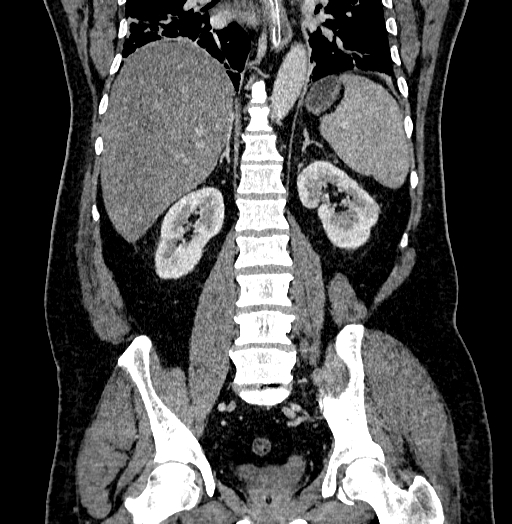 Acute appendicitis (Radiopaedia 79950-93224 Coronal C+ portal venous phase 62).jpg