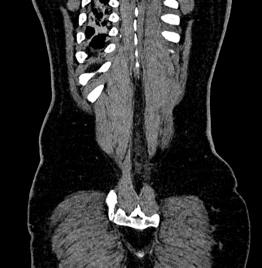 Acute appendicitis (Radiopaedia 79950-93224 Coronal C+ portal venous phase 88).jpg