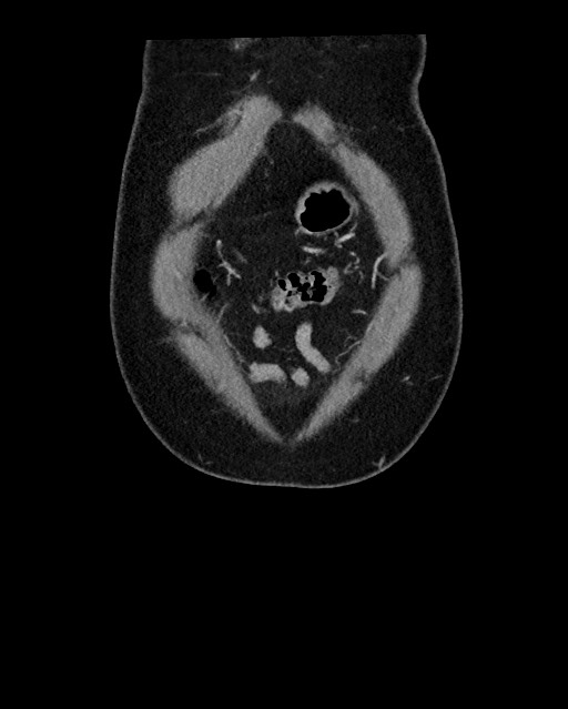 Acute appendicitis - large appendicoliths (Radiopaedia 61805-69820 Coronal C+ portal venous phase 17).jpg