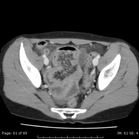 File:Acute appendicitis with appendicolith (Radiopaedia 23662-23801 Axial 2).jpg