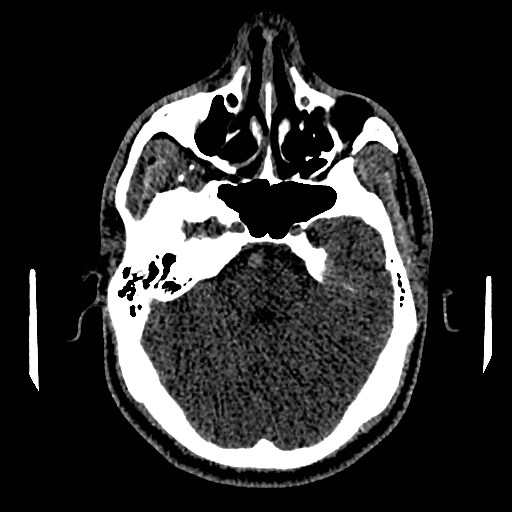 Acute basilar artery occlusion (Radiopaedia 43582-46985 Axial non-contrast 62).jpg