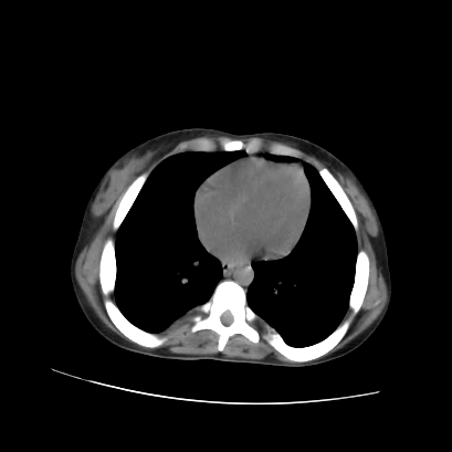 File:Acute calculous cholecystitis in patient with osteopetrosis (Radiopaedia 77871-90159 Axial non-contrast 9).jpg