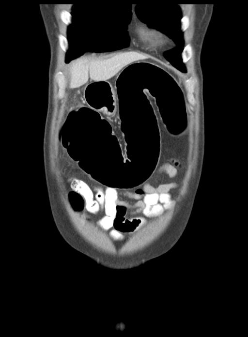 Acute cholecystitis (Radiopaedia 29814-30327 Coronal C+ portal venous phase 11).jpg
