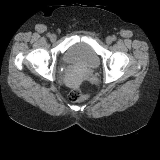 Acute cholecystitis and ureteric colic (Radiopaedia 42330-45444 Axial prone 105).jpg