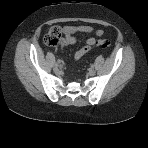 Acute cholecystitis and ureteric colic (Radiopaedia 42330-45444 Axial prone 83).jpg