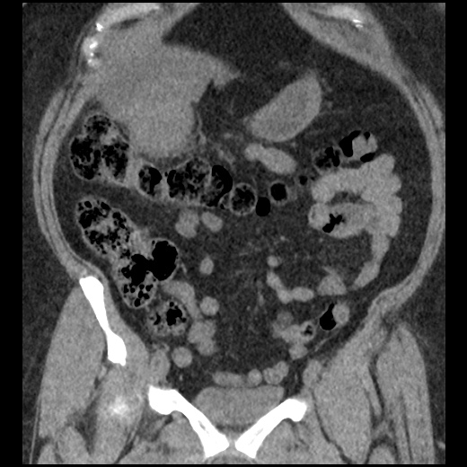 File:Acute cholecystitis and ureteric colic (Radiopaedia 42330-45444 Coronal prone 36).jpg