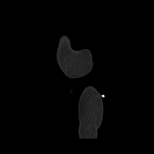 Acute cholecystitis with tensile fundus sign (Radiopaedia 71394-81723 Sagittal non-contrast 171).jpg