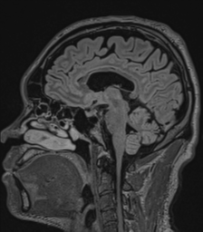 Acute disseminated encephalomyelitis (ADEM)- Anti-NMDA receptor encephalitis (Radiopaedia 54920-61201 Sagittal FLAIR 47).png
