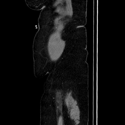 Acute diverticulitis - transverse colon (Radiopaedia 87063-103327 Sagittal C+ portal venous phase 42).jpg