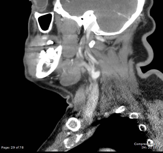 Acute epiglottitis (Radiopaedia 54375-60590 Sagittal C+ arterial phase 29).jpg
