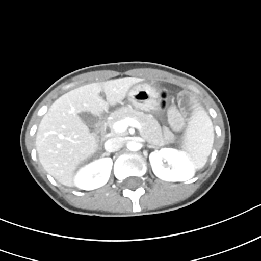 Acute gangrenous appendicitis with perforation (Radiopaedia 40152-42662 Axial C+ portal venous phase 20).png