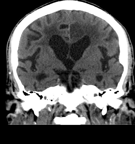 Acute left anterior cerebral artery territory infarction (Radiopaedia 51785-57578 Coronal non-contrast 29).jpg