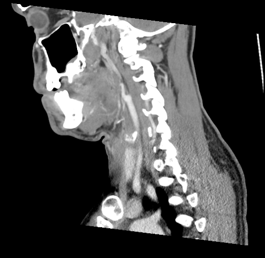 Acute longus colli calcific tendinitis (Radiopaedia 72495-83036 Sagittal C+ arterial phase 22).jpg