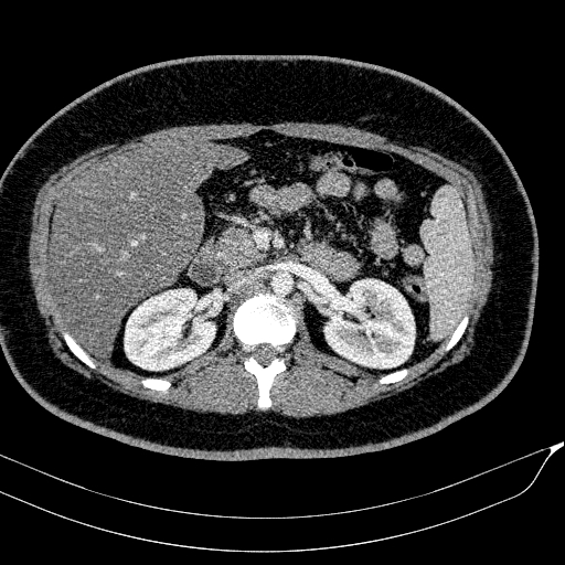 Acute on chronic pancreatitis (Radiopaedia 80902-94423 Axial C+ portal venous phase 67).jpg